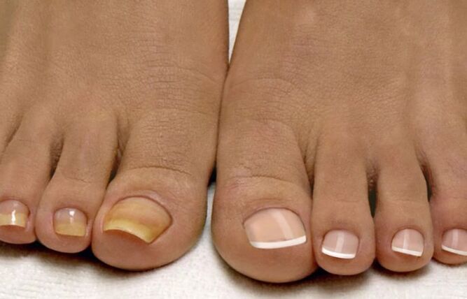 Nagelpilz