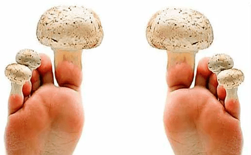 Pilze auf den Nägeln