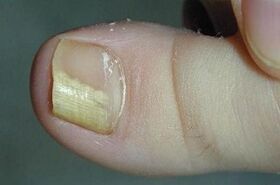 Die Gründe für das Aussehen des Pilzes am Daumen des Beins