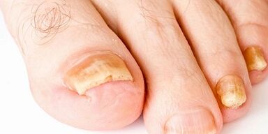 Wie und wie man den Nagelpilz behandelt