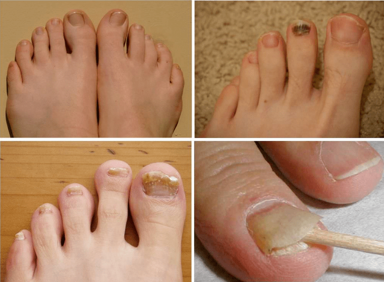 Anzeichen von Nagelpilzen