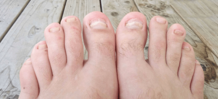 Nagelpilz