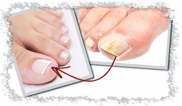 Ursachen von Nagelpilzen
