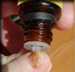 Auftragen von Tropfen auf einen von Pilz befallenen Nagel
